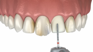 Zahnrat 118, Video 2, Veneers